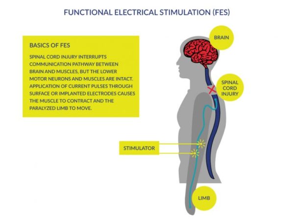 Neuromuscular Electrical Stimulation (NMES): What it is, how it is applied  and a summary of evidence 