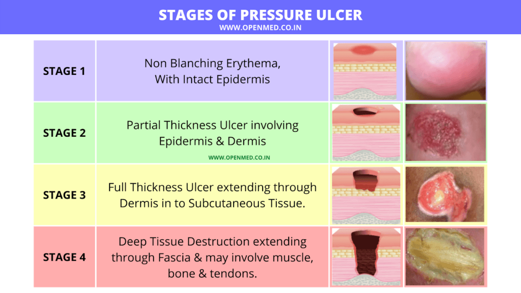 pictures of pressure ulcers in Stages 1, 2, 3, and 4