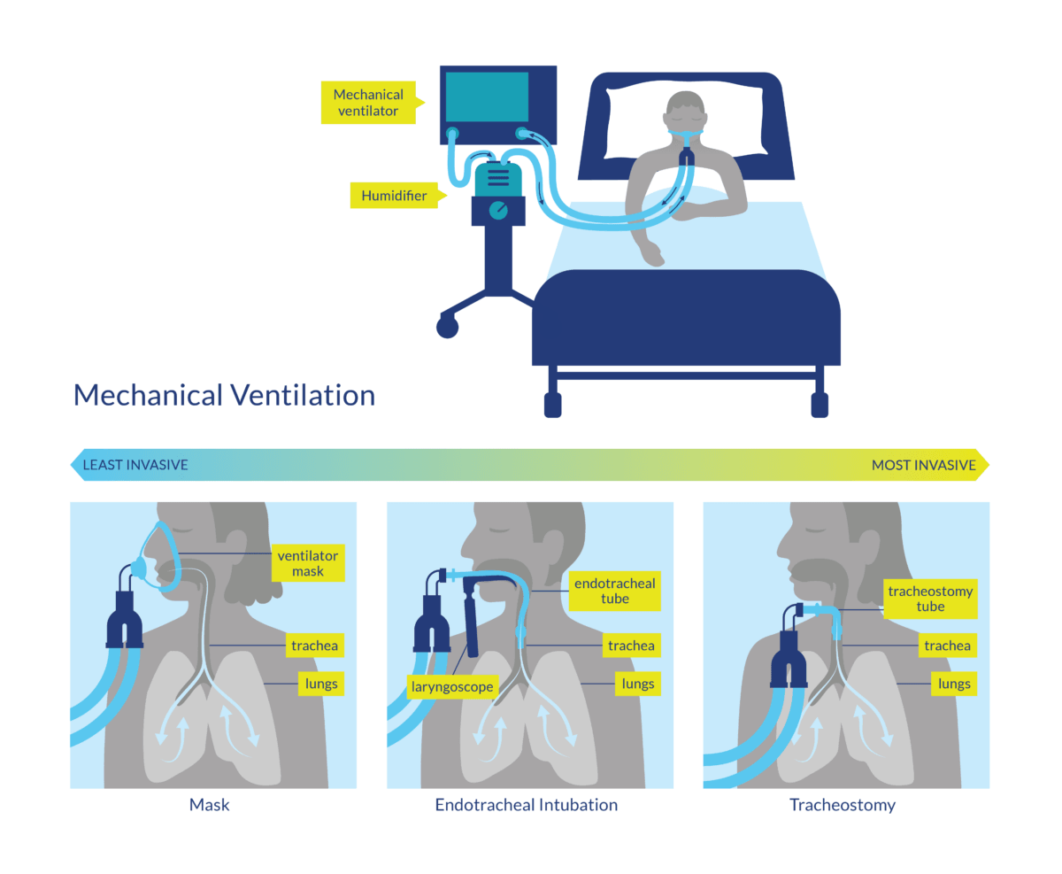 Why Is Mechanical Ventilation Required At Nathan Brodzky Blog