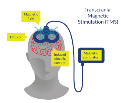 Figure 9. Transcranial Magnetic Stimulation (TMS)